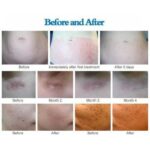 ⁦جهاز ديرما بن لعلاج الندبات والعناية بالبشرة والوجه من DR Pen Ultima A1⁩ - الصورة ⁦11⁩