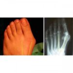 معالج مفصل الاصبع الطبي للقدم Night Foot Care Toe Correction - الصورة 8