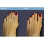 معالج مفصل الاصبع الطبي للقدم Night Foot Care Toe Correction - الصورة 9